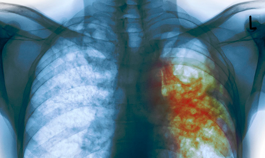 Бобруйские врачи-эпидемиологи рассказывают, что нужно знать о туберкулезе