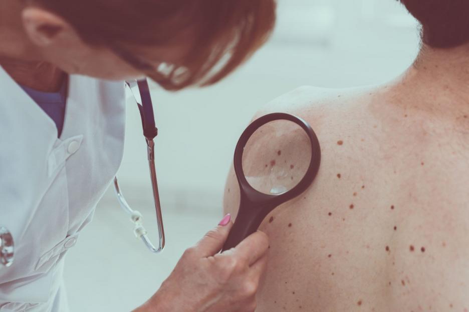 Почти 1 тысяча случаев рака кожи выявлена в Могилевской области в прошлом году